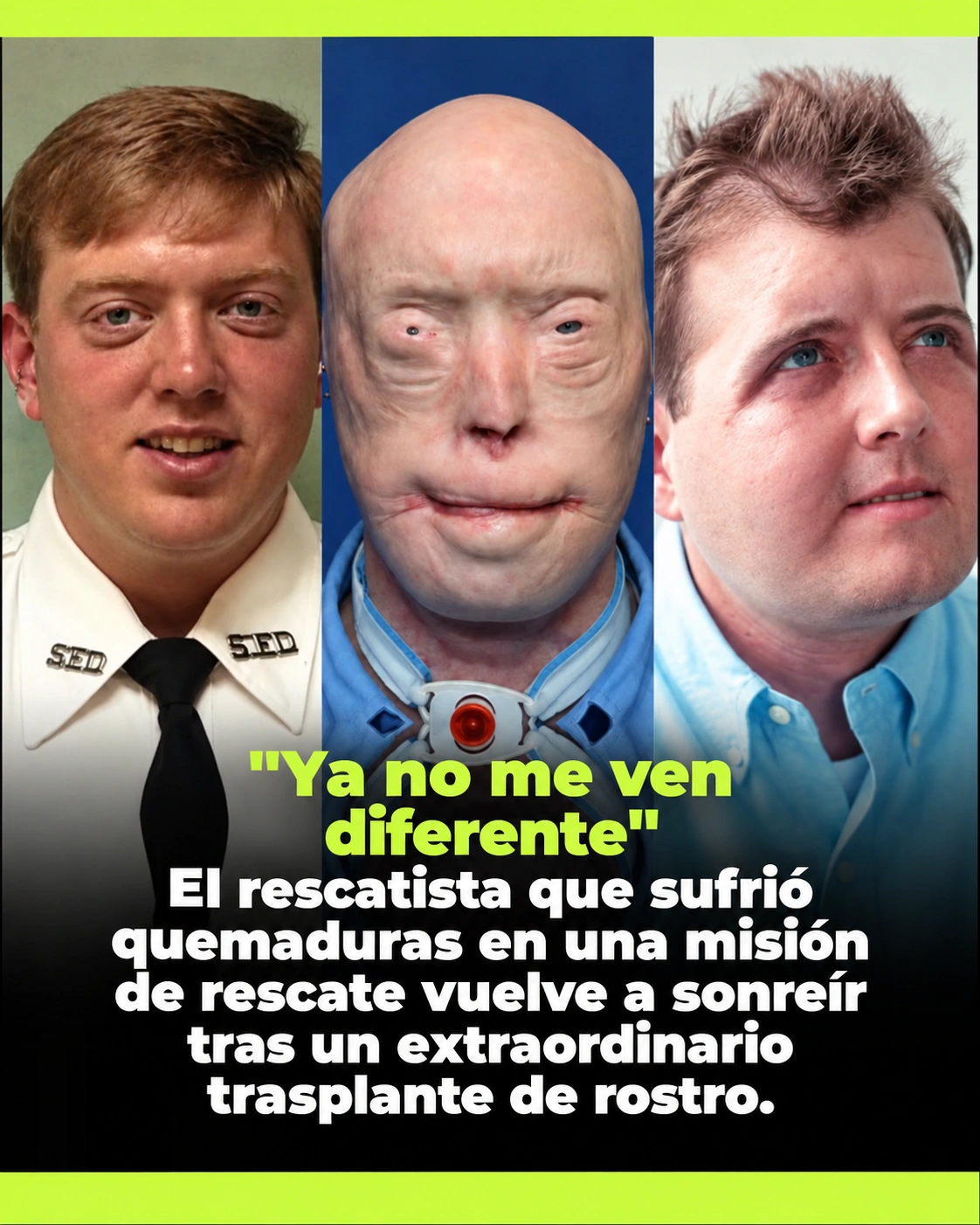 Patrick Hardison antes y después del trasplante facial