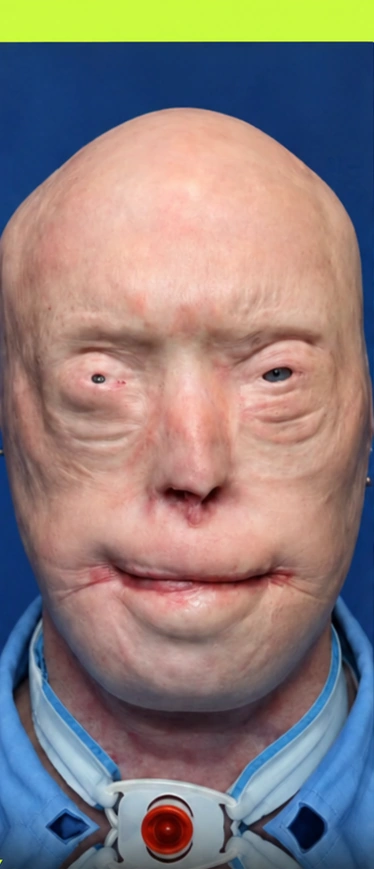Patrick Hardison después de sus graves quemaduras y antes del trasplante facial
