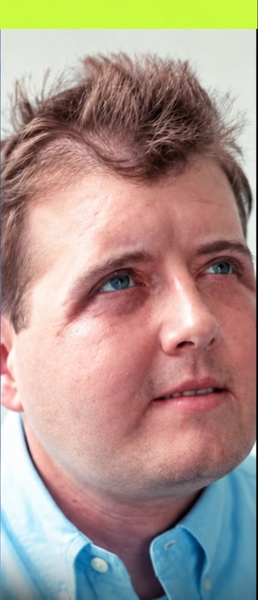 Patrick Hardison durante su recuperación después del trasplante facial
